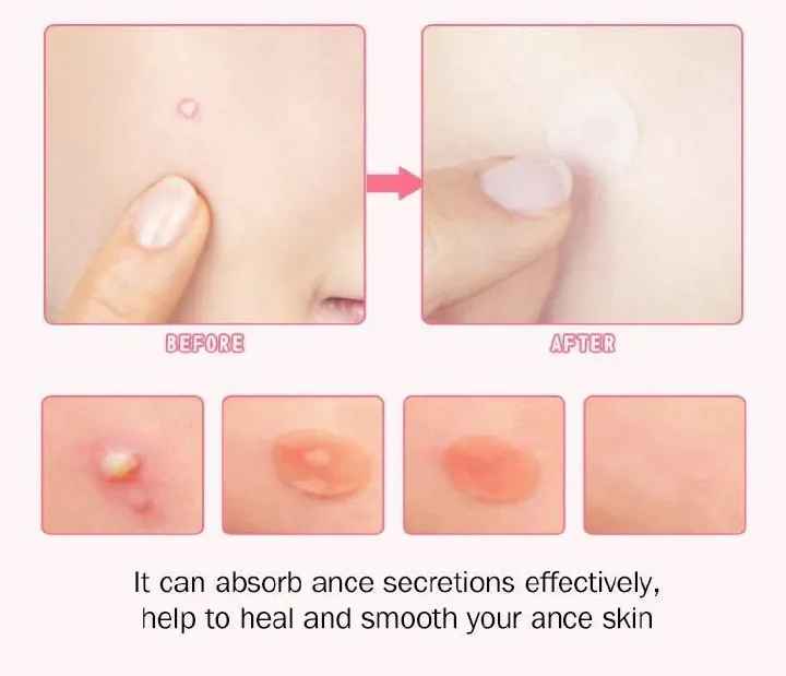 36 Patches Acne Pimple Patch Invisible Acne Removal Stickers Spot Pimple Treatment
