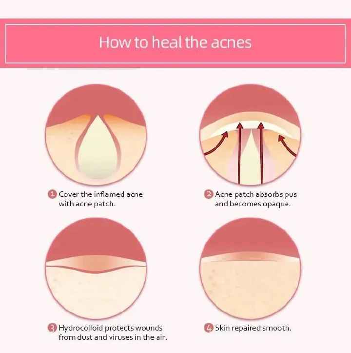 36 Patches Acne Pimple Patch Invisible Acne Removal Stickers Spot Pimple Treatment