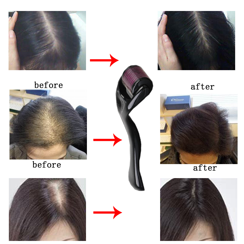 Micro Needles Micro-needling Roller for Hair Regrowth Beard Growth Thinning Hair Receding Hairline Bald Spots Black 0.25mm [分类版本2]