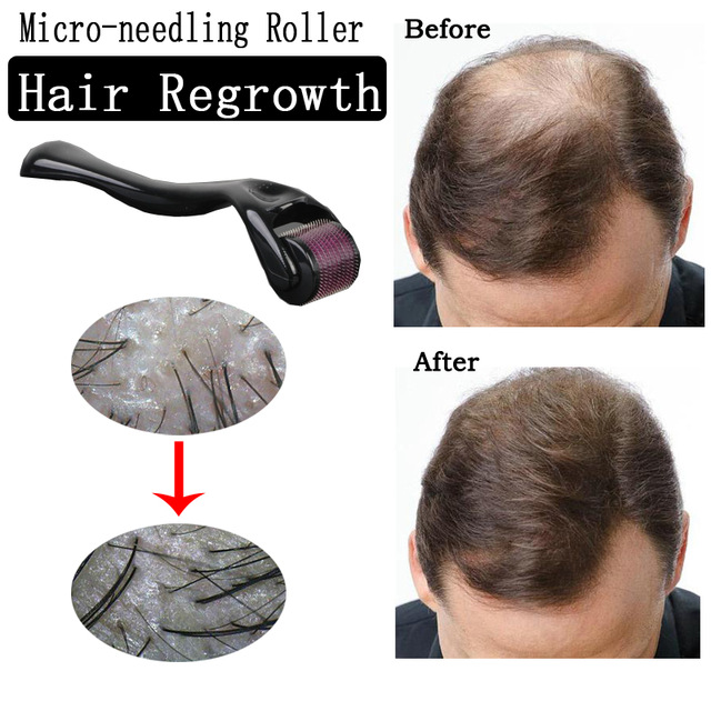Micro Needles Micro-needling Roller for Hair Regrowth Beard Growth Thinning Hair Receding Hairline Bald Spots Black 0.25mm [分类版本2]