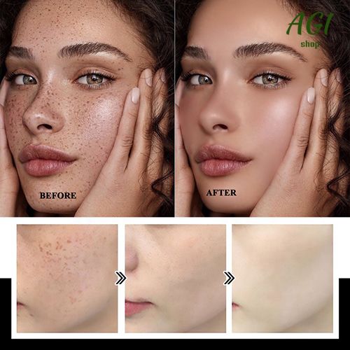 Face Skin Care Set Nicotinamide Whitening Freckles Cream + Facial Cleanser + Moisturizing lotion + Face Essence + Face Toner + Masks 5 Pcs  Remove Melasma Dark Spot Acne Marks Brightening Skin Tone