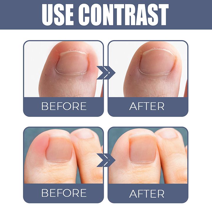 Toenail Nail Fungus Treatment Repair Fingernail Device Toenail Treatment for Foot Nail Fungus Essential Oil Onychomycosis Care