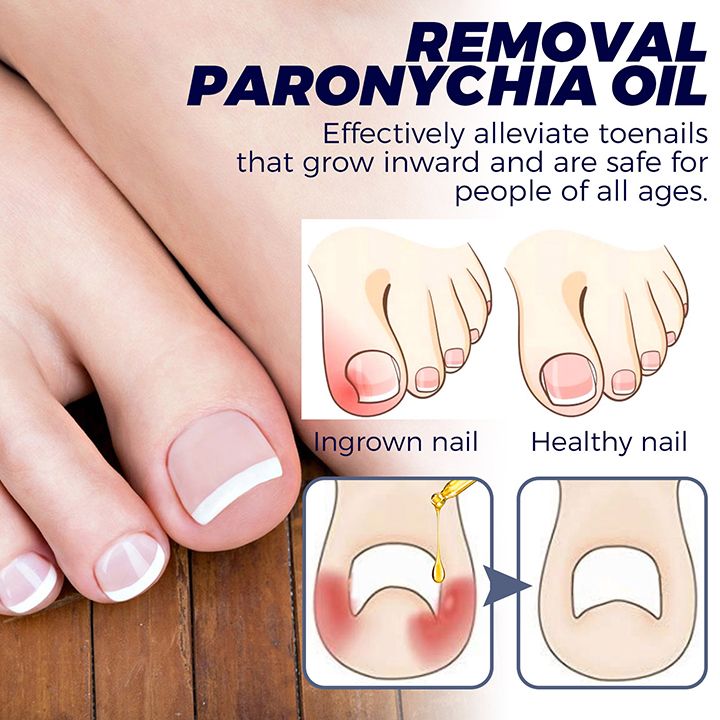 Toenail Nail Fungus Treatment Repair Fingernail Device Toenail Treatment for Foot Nail Fungus Essential Oil Onychomycosis Care