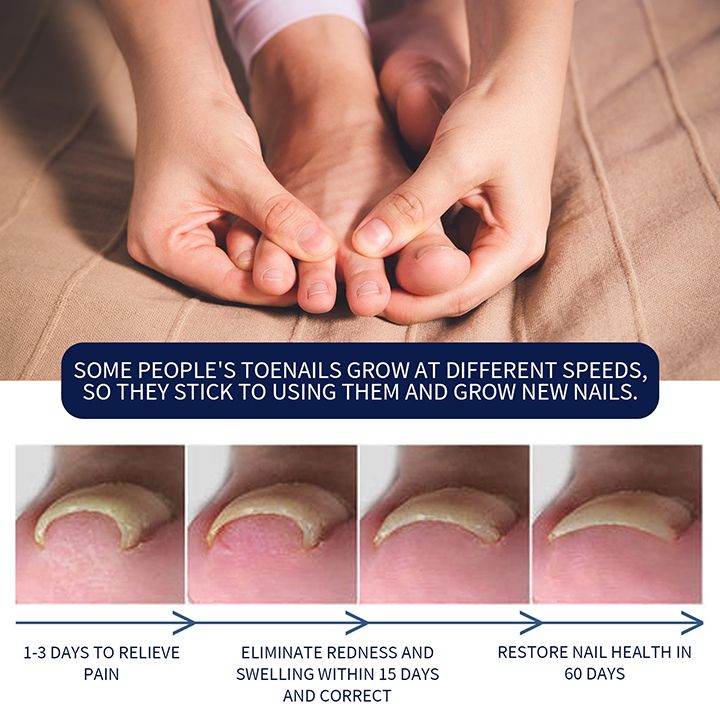 Toenail Nail Fungus Treatment Repair Fingernail Device Toenail Treatment for Foot Nail Fungus Essential Oil Onychomycosis Care