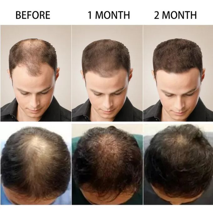 Sadoer 2 Pieces Ginger Hair Growth Serum + Anti Hair Loss Treatment Serum , Restores Lush Hair , Treat Alopecia, Effective in Hair Growth,Moisturizing and Softening Forked Hair, with ScalpCare