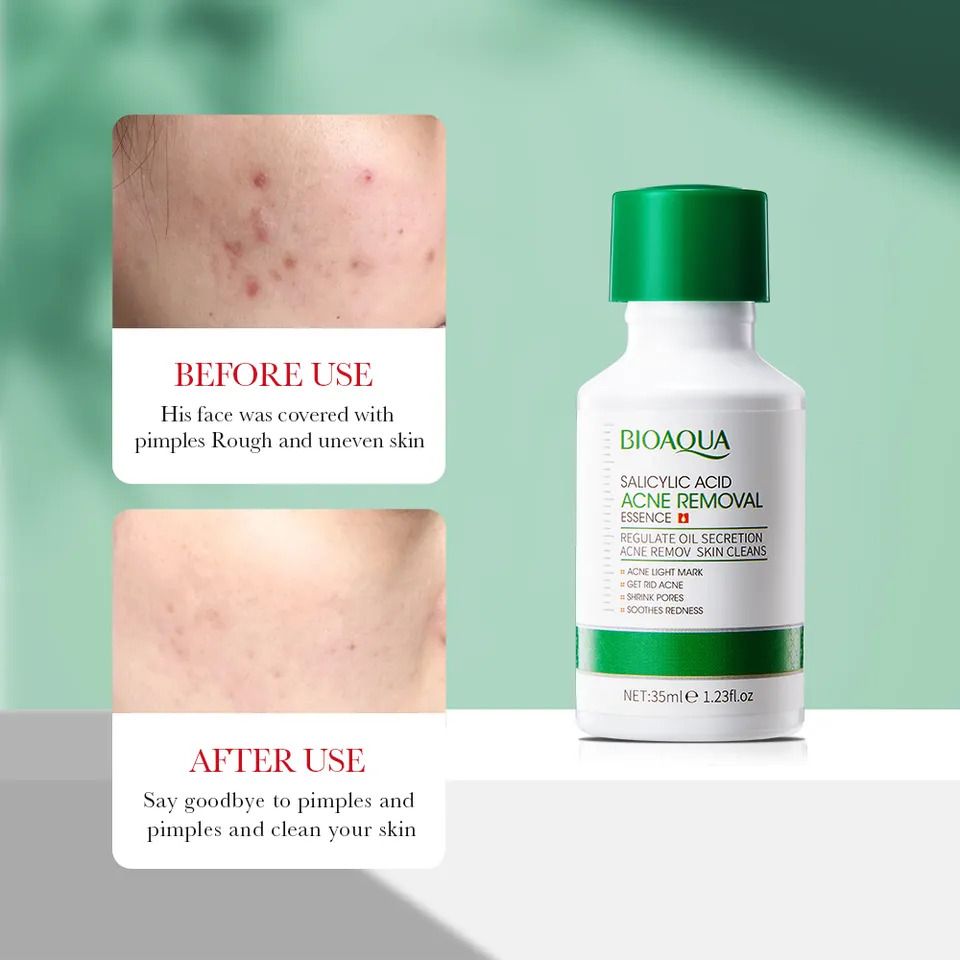 3 in 1 , Bioaqua Paw Paw Vitamin C Essence + Salicylic Acne Treatment Essence + Salicylic Acid Acne Removal Cleanser, For Acne Treatment, Oiul Control, Pore Shrinking , Anti Oxidation, Remove Acne
