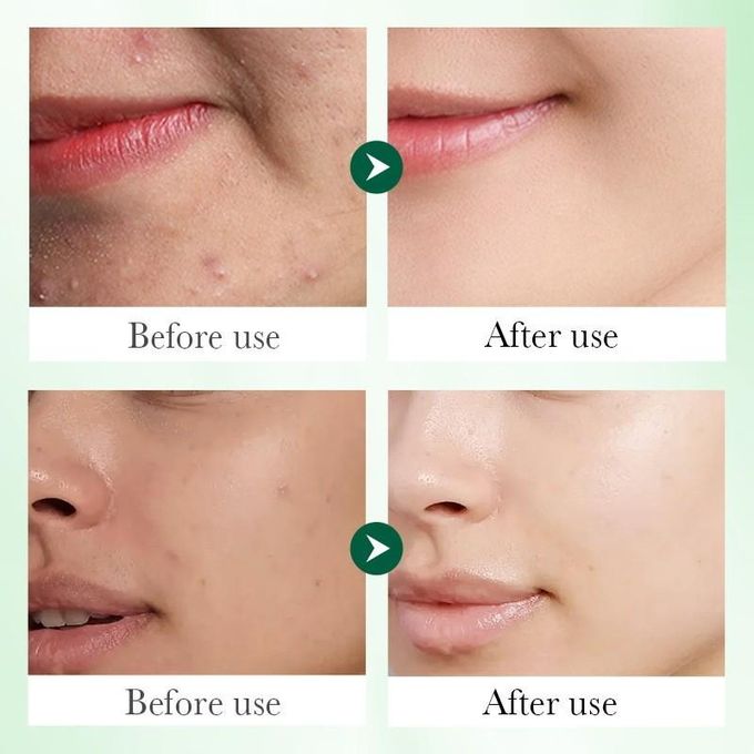 Sadoer Face Serum, Salicylic Acid Repair Serum with 3% Salicylic Acid, Collagen Peptide, Centella Asiatica and Niacinamide, Can add Vitamin C,Remove Acne, Moisturize, Improve Acne Scars, Shrink Pores