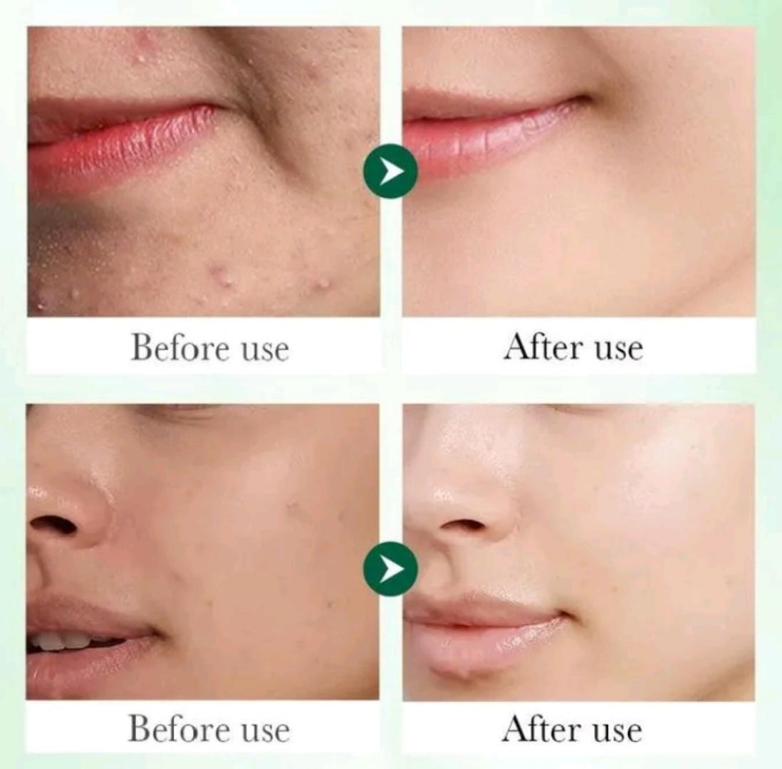 Sadoer Face Serum, Salicylic Acid Repair Serum with 3% Salicylic Acid, Collagen Peptide, Centella Asiatica and Niacinamide, Can add Vitamin C,Remove Acne, Moisturize, Improve Acne Scars, Shrink Pores