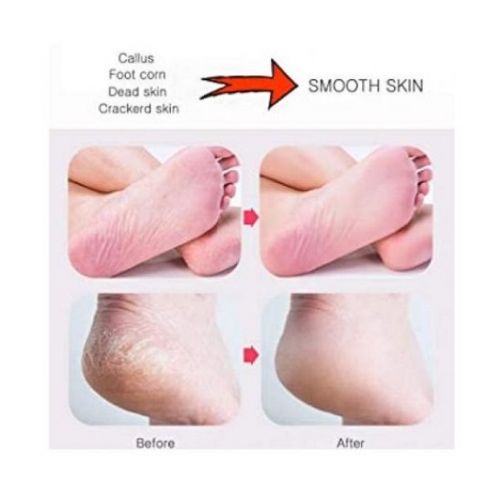 Pedicure Set - Foot Scrapper Pumice & Stone Dead Skin Callus Remover