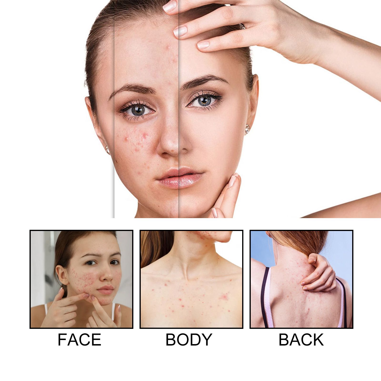 72pcs Acne Patch Acne Skin Care Product Acne Remover Acne Skin Care Acne Treatment Acne Removal Acne Control Cleanser Acne Cleanser Repair Acne Facial Skin Care Remove Acne Patch Remove Skin Acne