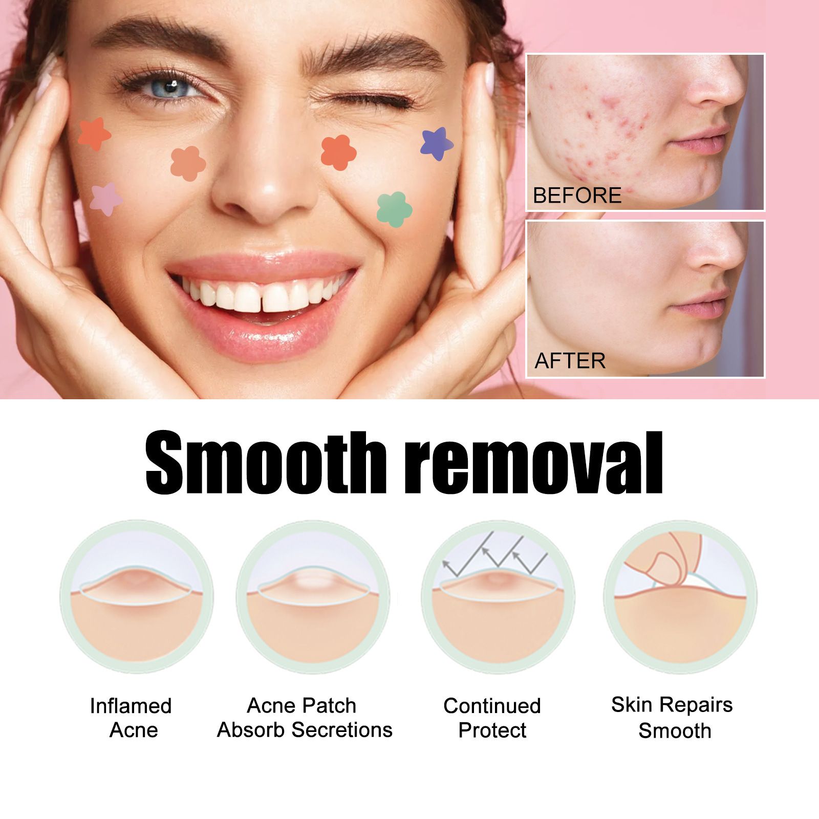 Free Get Gift 10pcs| SADOE 78pcs Acne Patch Acne Skin Care Product Acne Remover Acne Skin Care Acne Treatment Acne Removal Acne Control Cleanser Acne Cleanser Repair Acne Facial Skin Care Remove Acne