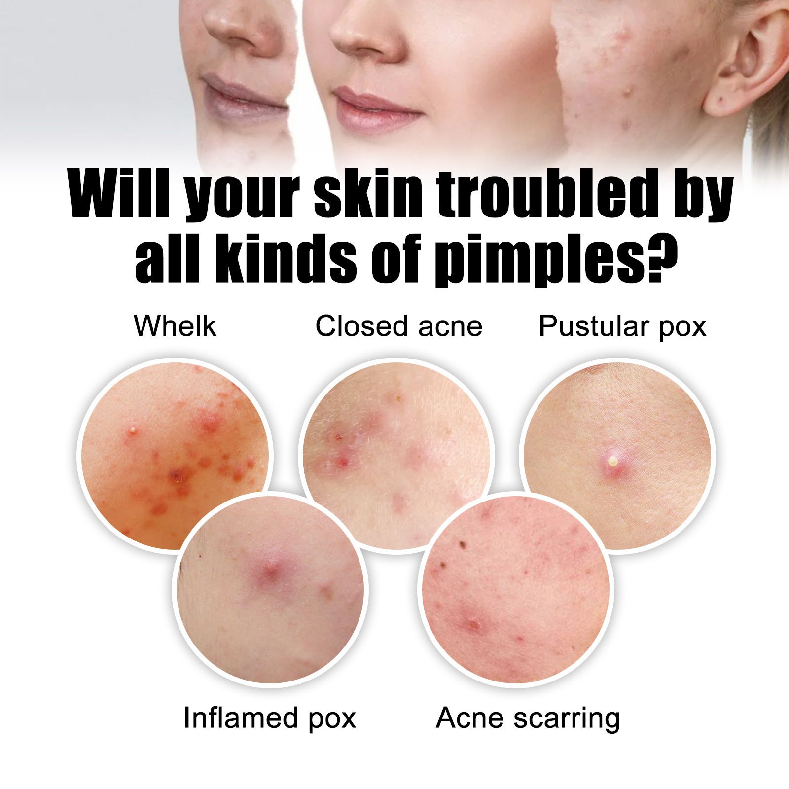 72pcs Acne Patch Acne Skin Care Product Acne Remover Acne Skin Care Acne Treatment Acne Removal Acne Control Cleanser Acne Cleanser Repair Acne Facial Skin Care Remove Acne Patch Remove Skin Acne