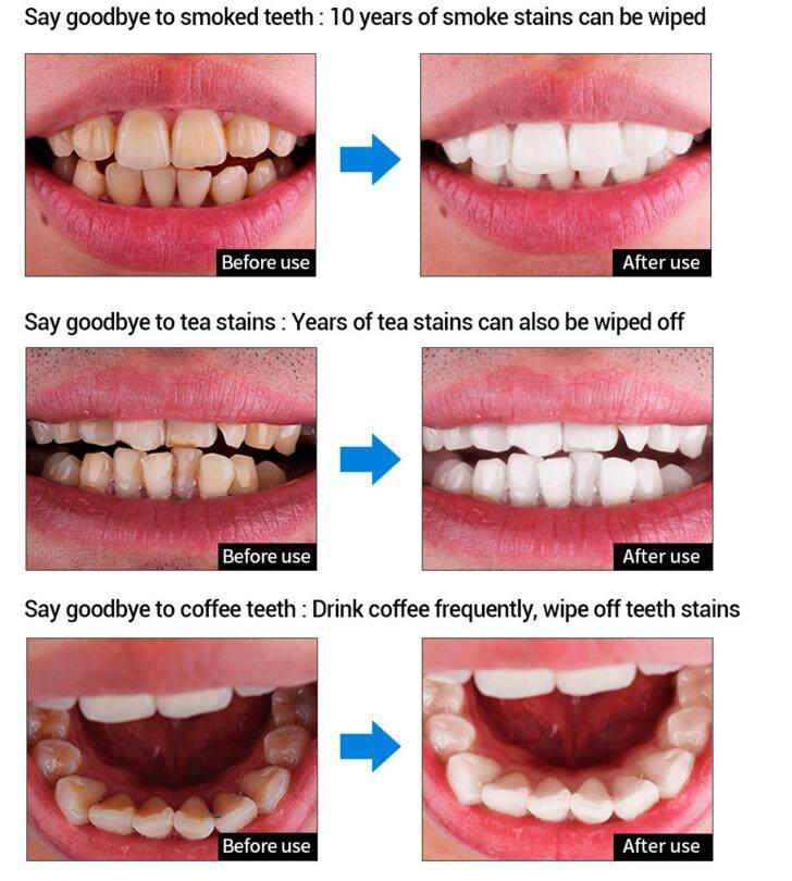 Quick and easy👍10ml Teeth Whitening Teeth Cleaning Mousse Mouthwash Toothpaste Remove Tartar Oral Health Stain Removal Freshen Breath Remove Plaque Stains Oral Odor Bright and tartar remover