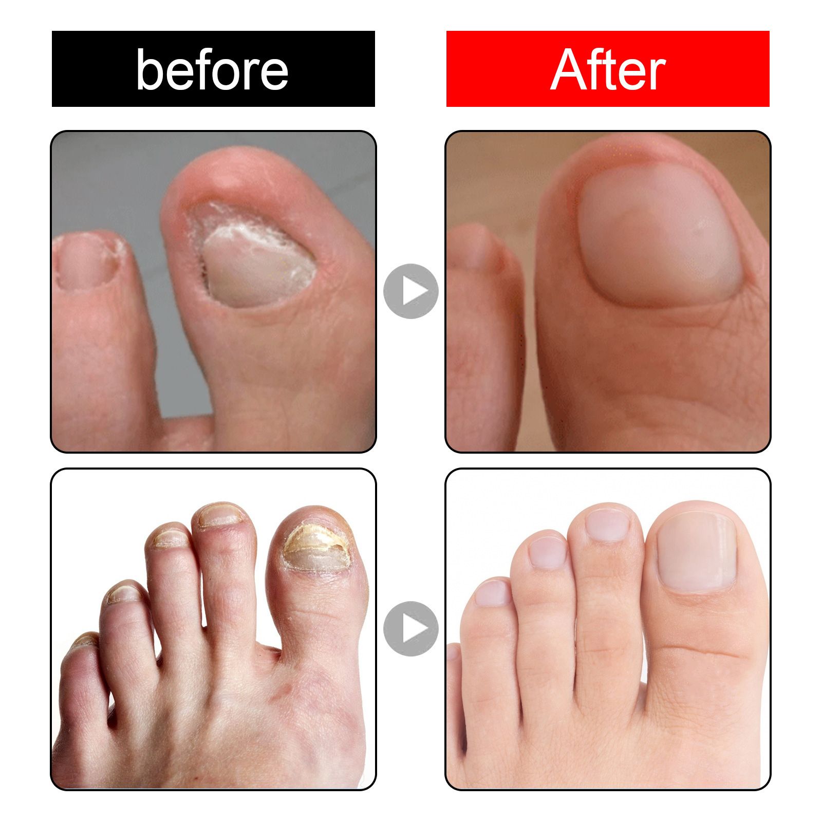 Onychomycosis Antibacterial，Ingrown Toenail Drops，solution Eliminate nail diseases on hands and feet painlessly for Thickening,Deformation，Brittle, Discoloured,Broken Nails