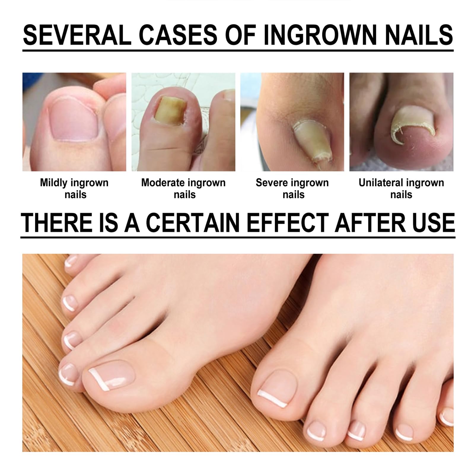 Onychomycosis Antibacterial，Ingrown Toenail Drops，solution Eliminate nail diseases on hands and feet painlessly for Thickening,Deformation，Brittle, Discoloured,Broken Nails