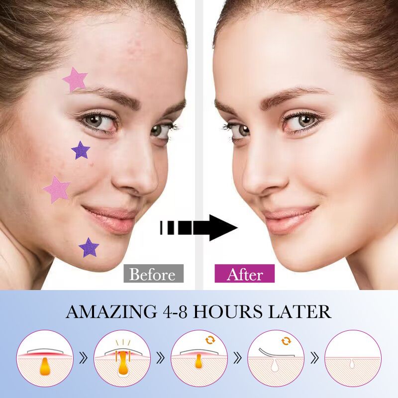 Free Get Gift 10pcs| SADOE 78pcs Acne Patch Acne Skin Care Product Acne Remover Acne Skin Care Acne Treatment Acne Removal Acne Control Cleanser Acne Cleanser Repair Acne Facial Skin Care Remove Acne