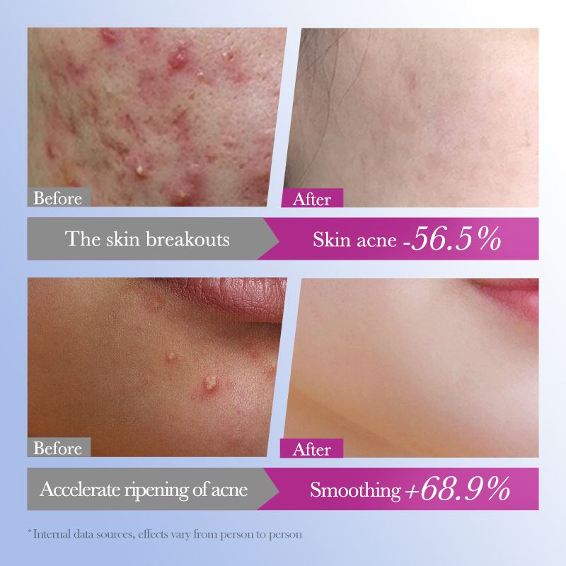 Free Get Gift 10pcs| SADOE 78pcs Acne Patch Acne Skin Care Product Acne Remover Acne Skin Care Acne Treatment Acne Removal Acne Control Cleanser Acne Cleanser Repair Acne Facial Skin Care Remove Acne