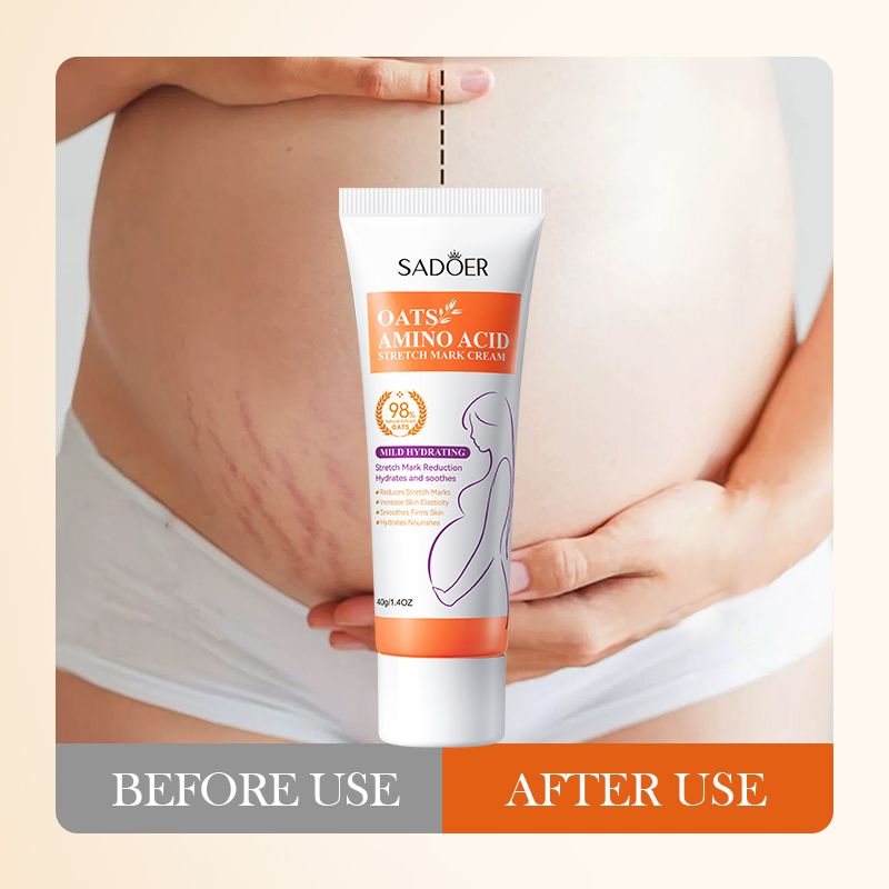 SADOER Stretch Mark Removal Cream Removes Stretch Mark Oil Body Legs Belly Legs Stretch Marks Removal Women Repair Anti-Aging Anti-Winkles Cream Increase Elasticity Smooth Firm Skin Care