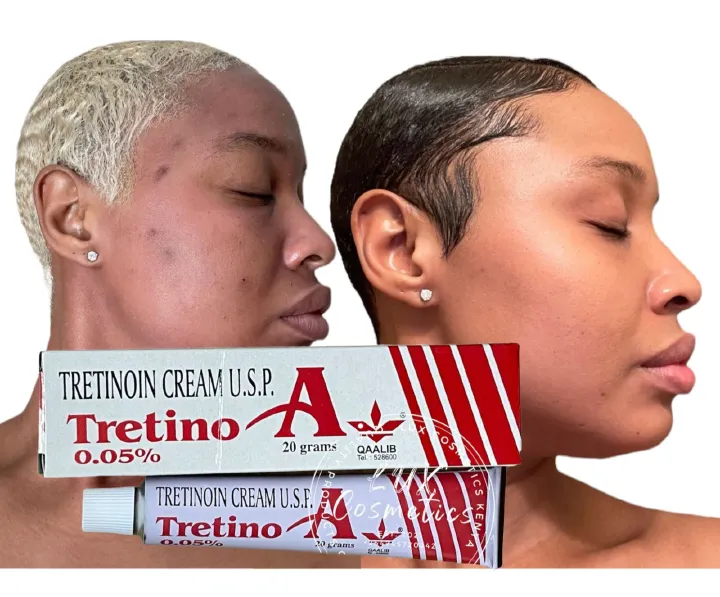 Tretinoin (Hydroquinone Mometasone) Hyperpigmentation Melasma Acne Dark Spots Scars Real Skin Soft & Beauty Clear Skin Coral's Golden Beauty Nitroskin Acnesol 10 days cream RDL RX3 RX2