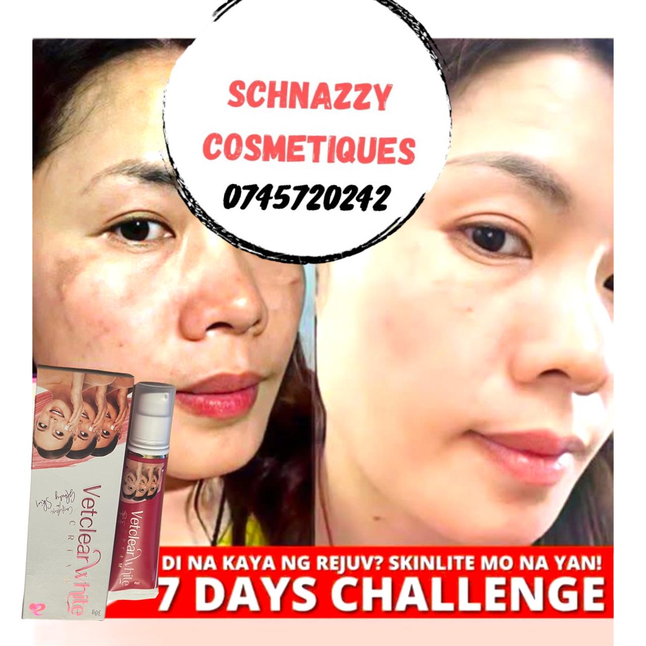 Tretinoin (Hydroquinone Mometasone) Hyperpigmentation Melasma Acne Dark Spots Scars Real Skin Soft & Beauty Clear Skin Coral's Golden Beauty Nitroskin Acnesol 10 days cream RDL RX3 RX2