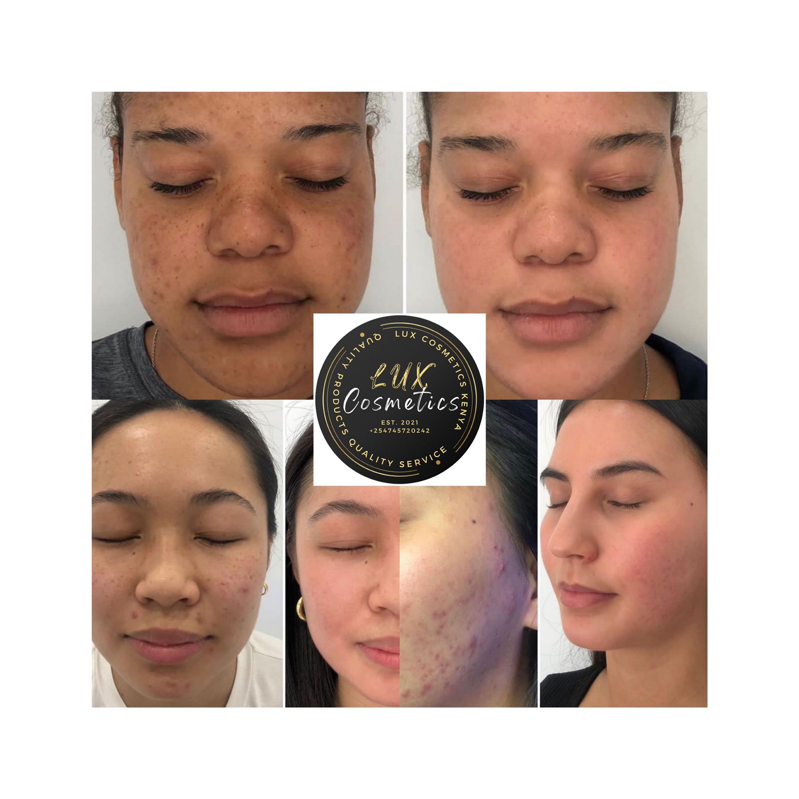 RETIN A Tretino Cream 0.05% Tretinoin Fade Scars Dark Hyperpigmentation Acne Dark Spots. Night Use Best for spot treatment clear skin routine Gentle exfoliate dull skin Antiaging Retinol Trino White