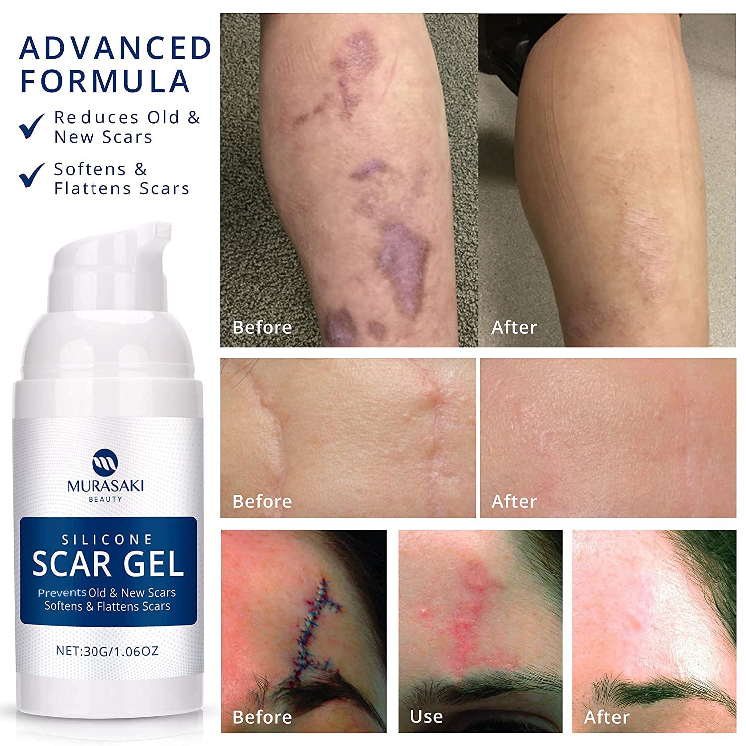 Silicone Scar Removal Gel Removal Skin Scars Cream Treat Surgery Scars Stretch Marks Acne Pox Prints Burn Repair Facial Care Gel Whitening Pigmentation Corrector.