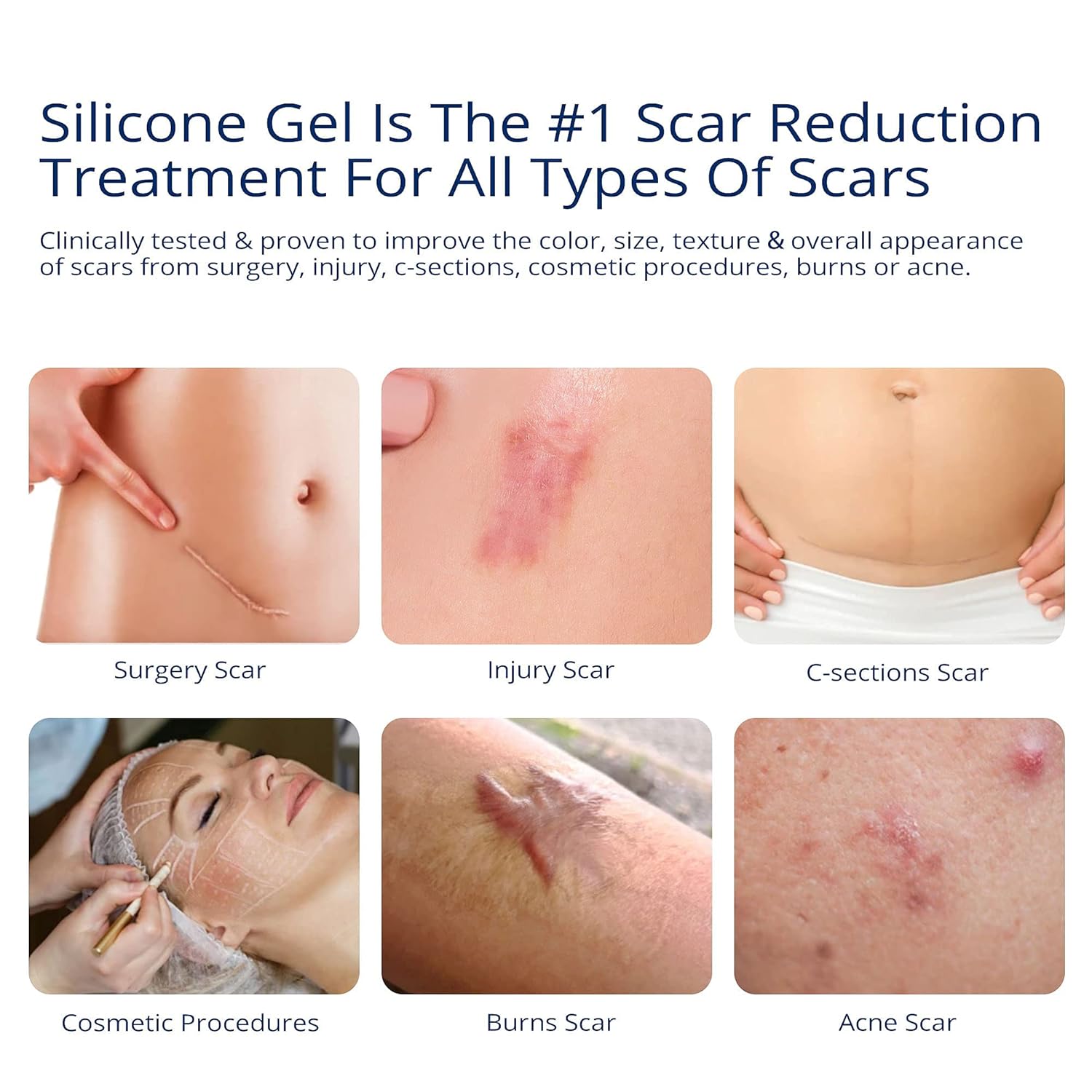 Silicone Scar Removal Gel Removal Skin Scars Cream Treat Surgery Scars Stretch Marks Acne Pox Prints Burn Repair Facial Care Gel Whitening Pigmentation Corrector.