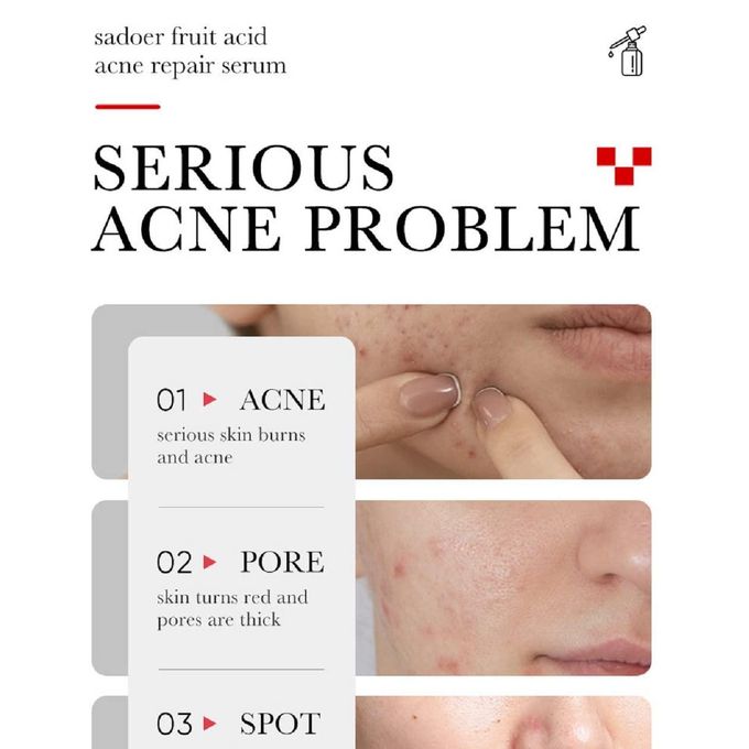 Sadoer AHA + BHA Fruit Acid Acne Repair Serum, With Salicylic Acid , Shrinks Pores, Eliminates Acne, Nourish and Smoothens Skin, Repair Acne Marks, Can Combine with Vitamin C, Moisturize, Black Heads