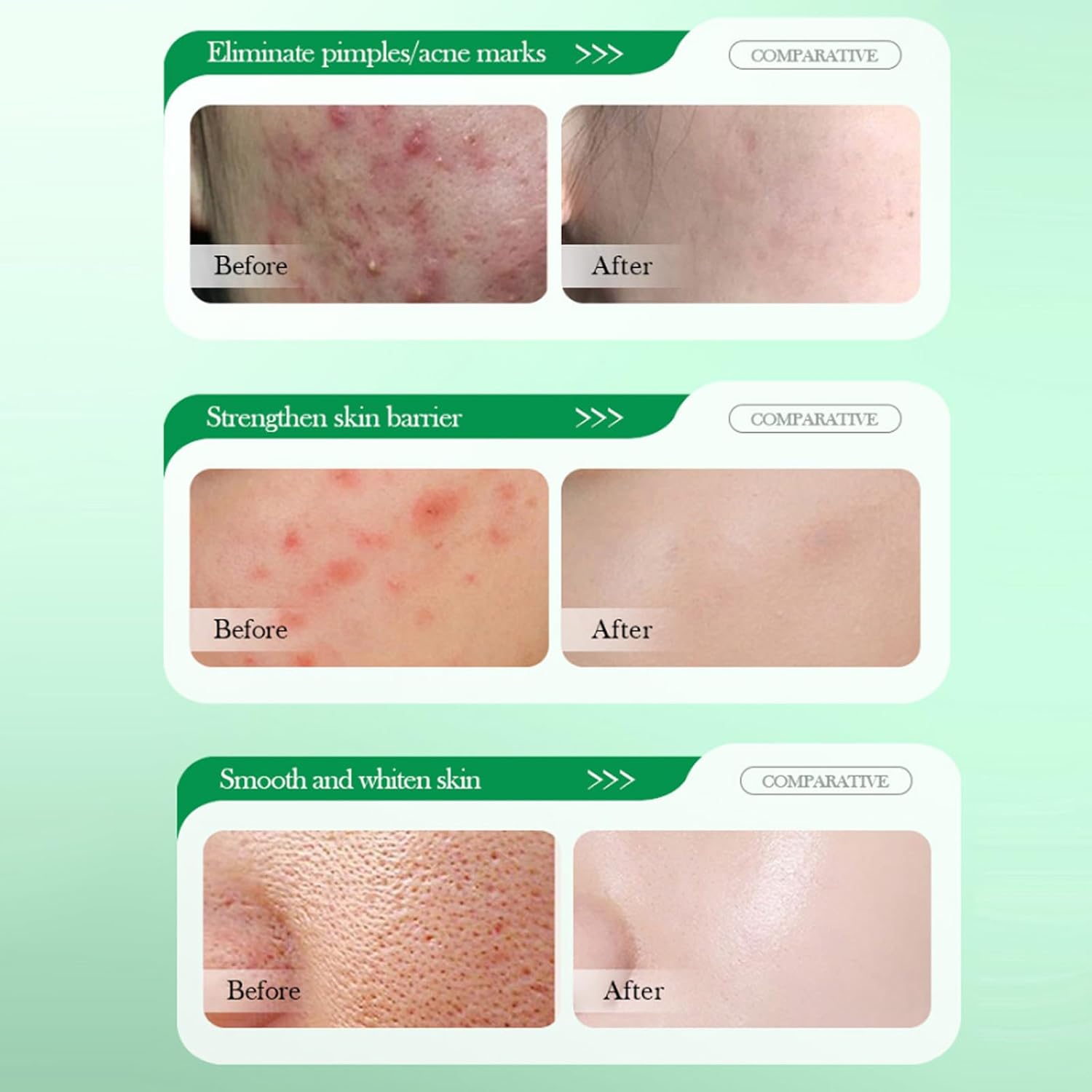 Salicylic Acid Repair Cream,Salicylic Acid Face Moisturizer,Pore Shrinkage Acne Skin Improves Acine Scars Motsturizing,Suitable for Oily, Acne Prone Skin