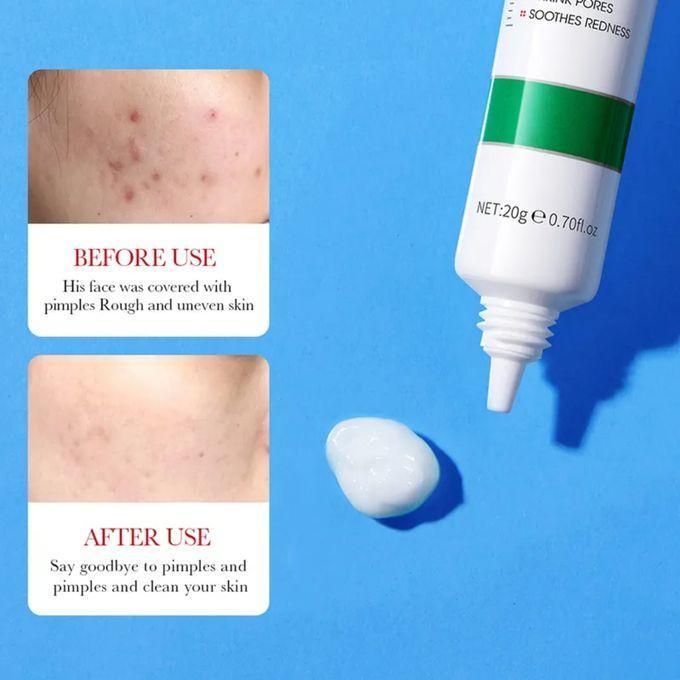 BIOAQUA Salicylic Acid Acne Cream,Fades Acne Marks, Eliminates Pimples, Remove Acne, Soothes Redness, Shrink Pores Regulates Oil Secretion Eliminating Pimples, Black Heads, Pimples, Acne  Fades