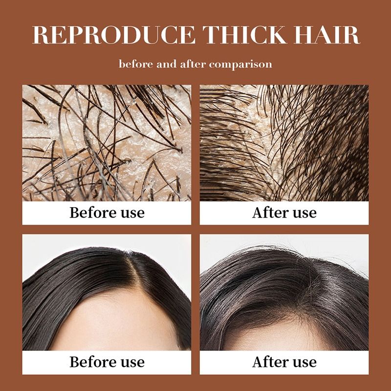 2 in 1 Hair Shampoo+Anti Hair Loss Essense SERUM Treatment Shampoo Essence, Hair Growth Ginger Extract Beard Growth,Hair Growth, Anti Dandruffs Hair Moisturizing Hair Care Shampoo, Derma Roller Compli