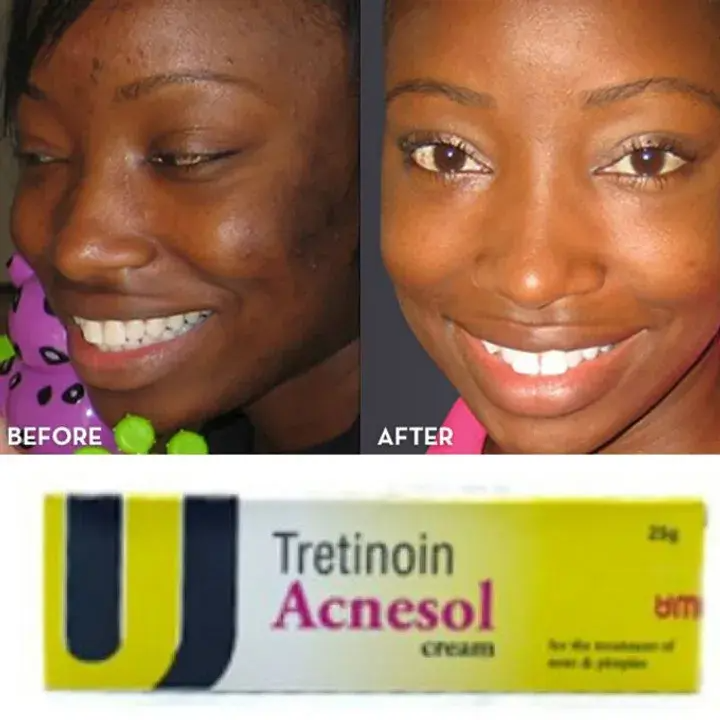 Tretinoin Acnesol Cream Treats Acne & Pimples