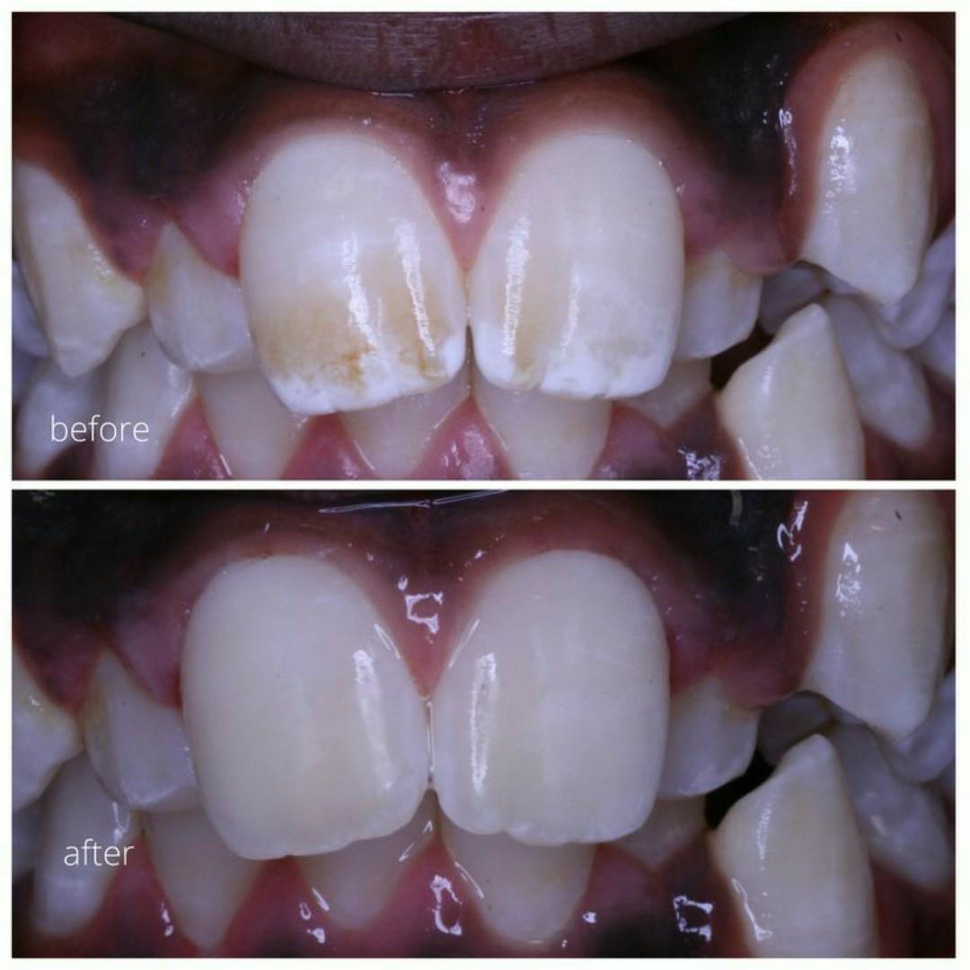 tooth savior powder