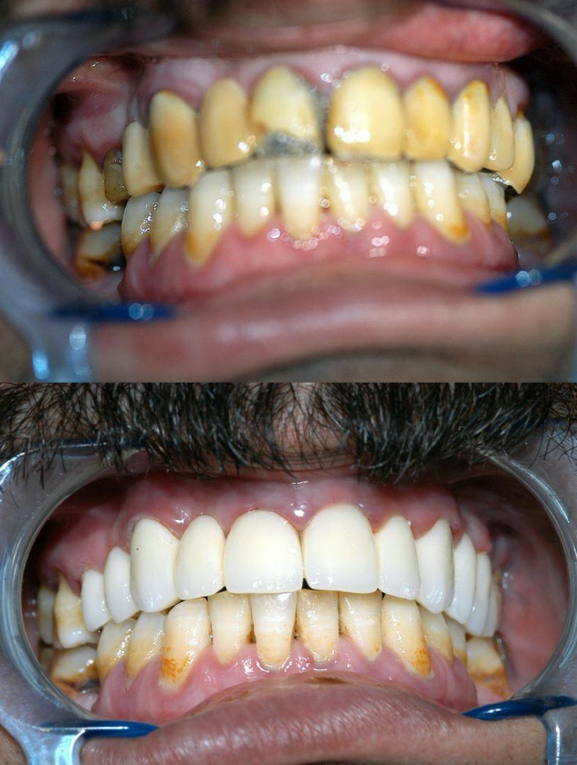 tooth savior powder