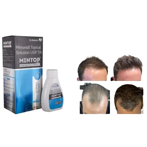 Minoxidil 5% Solution Mintop Forte Restores Hair Prevents Male Pattern Baldness