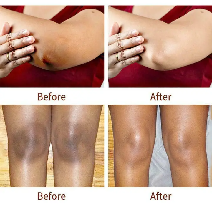 Dark Knees and Elbows Lightening Cream Body Whitening Cream