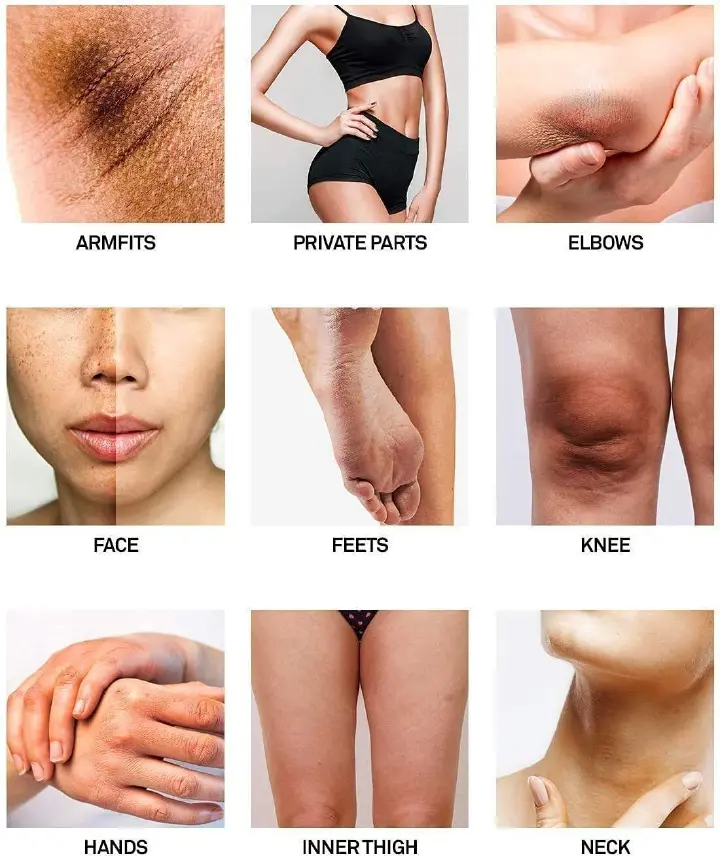 Dark Knees and Elbows Lightening Cream Body Whitening Cream