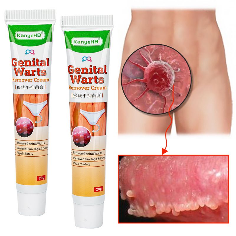 20g Genital Wart Herpes Remover Ointment Skin Tags Mole &amp; Papillomas Wart Remover Condyloma Acuminatum Treatment Cream