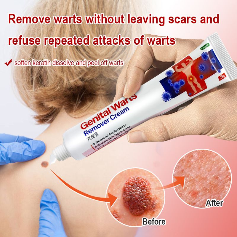 Anal Condyloma Cream 20g Treatment Genital Wart Ointment Vulva Herpes Condyloma Acuminatum Skin Tag Painless Remover