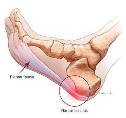 Orthopedic Plantar Adjuster Arch Support Orthotic Insole Flat Foot Corrector Pedicure Insoles Cushion Pad for Foot Care
Arch Support Shoe Insoles Flat Foot Plantar Fix Fasciitis
