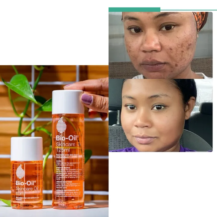 Bio Skincare Oil for Scars Stretchmarks Hyperpigmentation Moisturising Improve Appearance of Uneven Skin Tone Softer Smoother More Supple Faster Wound Healing New Arrivals Bio Oil