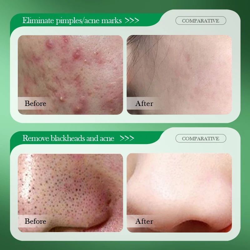 SADOER Salicylic Acid Repair Cream,Salicylic Acid Face Moisturizer,Pore Shrinkage Acne Skin Improves Acine Scars Motsturizing,Suitable for Oily, Acne Prone Skin