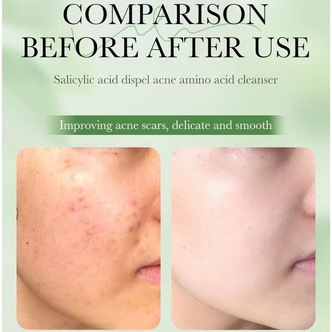 SADOER 2 in 1 Acne Repair Serum+Cream Salicylic Acid 3% Amino Salicylic Acid Oil Control Essences Cleanser,Contains Centella Asiatica, Niacinamide and Collagen Salicylic Acid Salycilic Acid