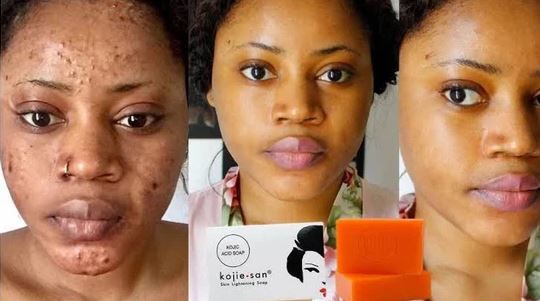 3pcs set Kojic acid soap brightening/lightening/whitening zero pigment body face kojie san soap