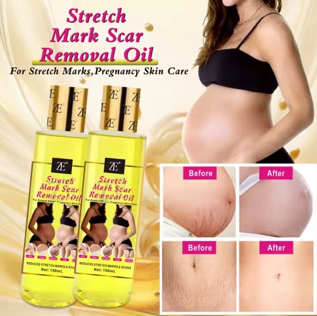 Quality Body Stretch Marks Oil Pregnant Scar effective Repair Remover Argan oil Vitamin C Stretch Marks Scar Removal Oil
