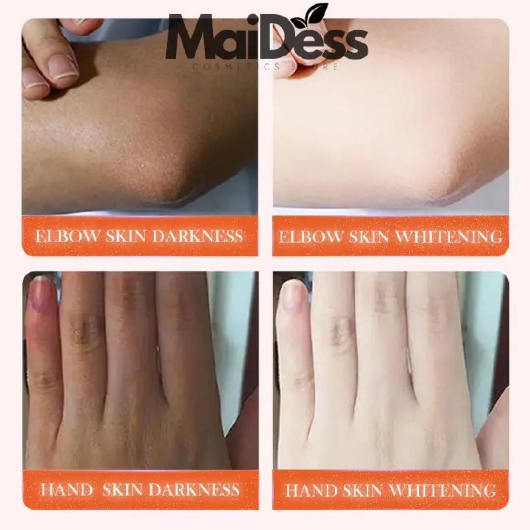 Sadoer Complete Dark Knuckle Set; Dark Knuckle Cream+Serum+Hand masks+Foot Masks