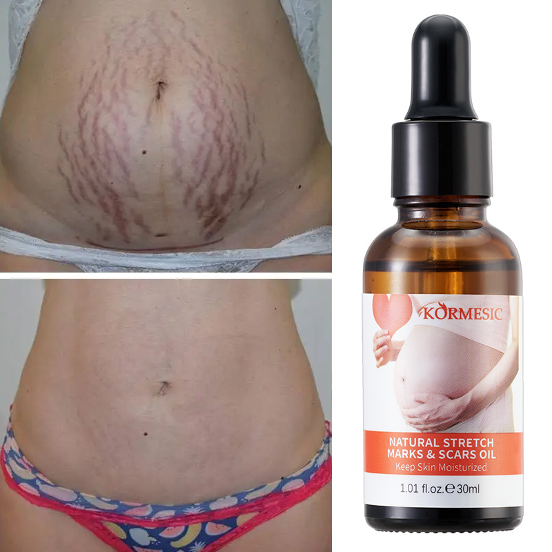 Stretch Marks Remover Skincare Body Oil Serum, Face and Body Moisturizer for Scars, Stretch Marks, Scars Repair, Abdominal Firming, and Gentle Stretch Marks Eradication All Skin Types - KORMESIC -