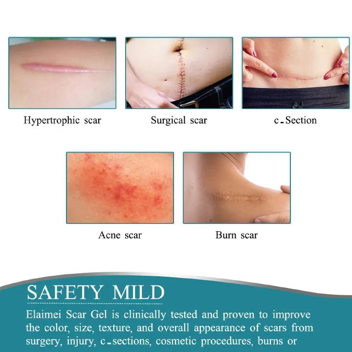 2Roll Silicone Scar Sheets Keloid Bump Removal Strips, Scar Reducing Treatments Surgical Scars,Burn,Tummy Tucks,Acne,C-Section