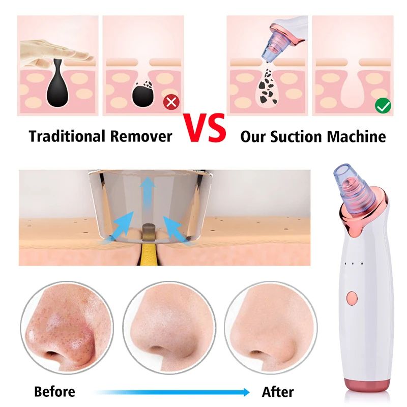 5 in 1 Blackhead Remover Diamond Dermabrasion Nose Vacuum Pore Cleanser Acne Pimple Suction Extractor USB Rechargeable Skin Care Tool