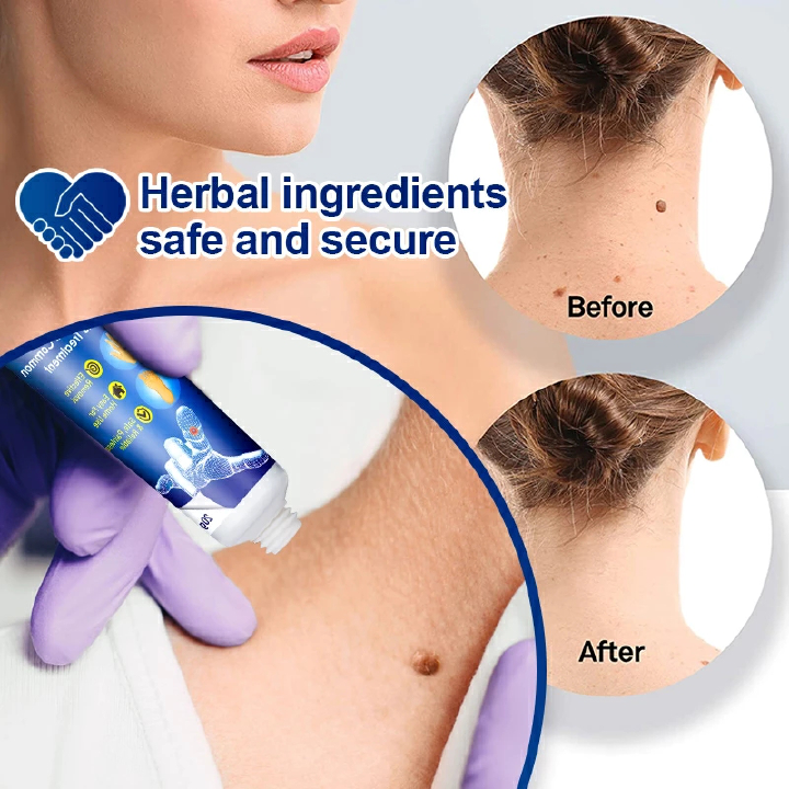 Sumifun Warts Remover Antibacterial Ointment Wart Treatment Cream Skin Tag Remover Herbal Extract Corn Plaster Warts Ointment